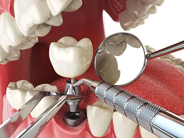 Best Broken or Chipped Tooth Repair in Stanford, CA